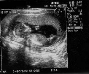 feto a 14 settimane di gravidanza