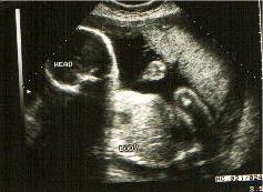 feto a 15 settimane di gravidanza