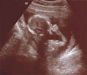ecografia feto a 17 settimane
