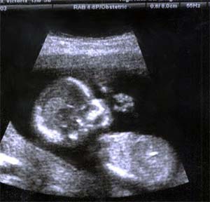 ecografia feto a 18 settimane