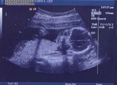 ecografia feto a 19 settimane