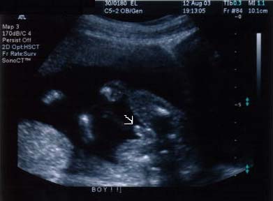 ecografia feto maschio a 20 settimane