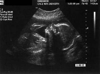 feto a 23 settimane