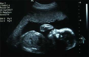 feto a 24 settimane di gravidanza
