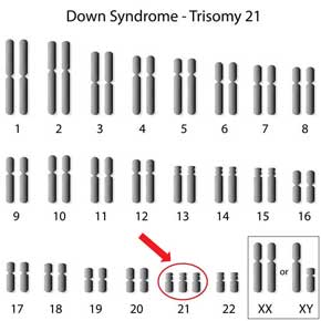 trisomia 21